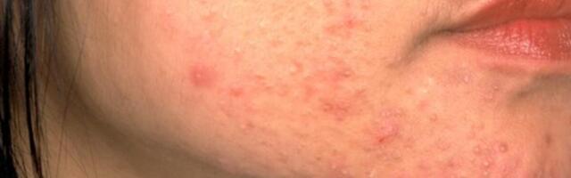 OPREZ! RODITELJI, OBRATITE PAŽNJU NA OVO! Ove navike mogu spasiti kožu vaše dece od akni, VAŽNO JE DA POČNETE ODMAH