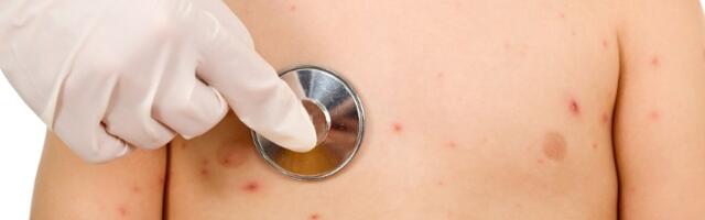 Još tri slučaja malih boginja u Beogradu