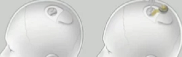 Evo šta se krije iza suludog plana milijardera! Posle svinje i ljudima će ugraćivati čipove u mozak!