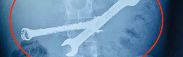 NE ZNAJU KAKO JE ŽIV! Mladić (26) se žalio na bolove u stomaku: Kad je stigao rendgenski snimak, nastao muk