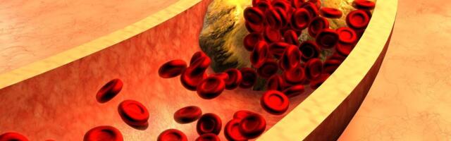 Američki kardiolozi objavili nove smernice za holesterol: Ključ je u preventivi