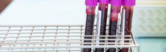 5 znakova da imate anemiju: Promene na licu mogu biti znak malokrvnosti - Telo šalje upozorenje