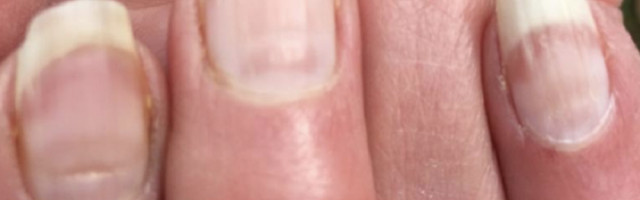 Hrapavi nokti takođe mogu biti simptom infekcije koronavirusom