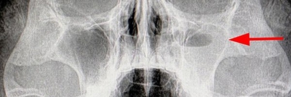 Hronični sinusitis i njegova veza sa promenama moždanih aktivnosti