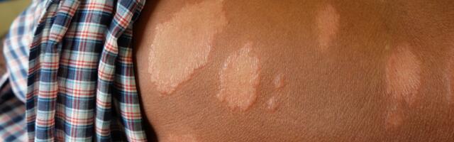 Nožić: Lepra jebolest koja se teško prenosi, rizik od zaraze je mali