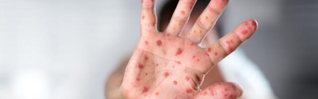 446 zaraženih, najviše deca: Smrtonosni virus se širi u komšiluku