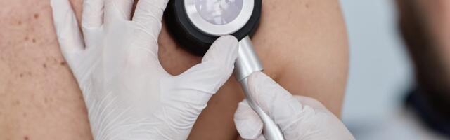 Zašto je Srbija u vrhu Evrope po smrtnosti od melanoma?