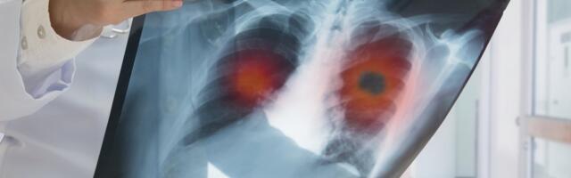 PLUĆA "PUCAJU" KAO KOKICE Ruski lekari definisali nove simptome ove bolesti: Sad je lakše otkrivaju