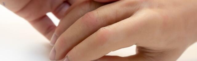 Ako primetite da su vam otekli prsti na rukama, ovo obavezno izbacite iz ishrane: Telo vam šalje upozorenje