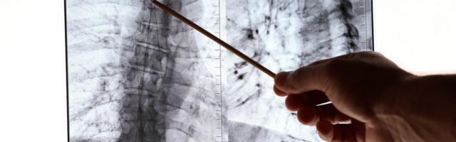 Veliki pomaci u lečenju plućne hipertenzije u Srbiji - dostupne saveremene terapije