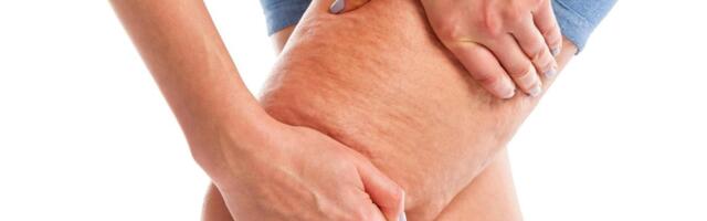 Kako koristiti kokosovo ulje protiv celulita: Trikovi za zategnutiju i mekšu kožu