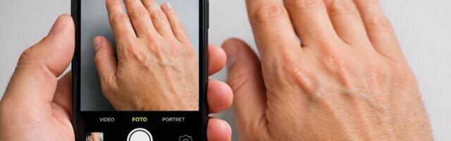 Fotografija vaše ruke mogla bi otkriti redak zdravstveni poremećaj